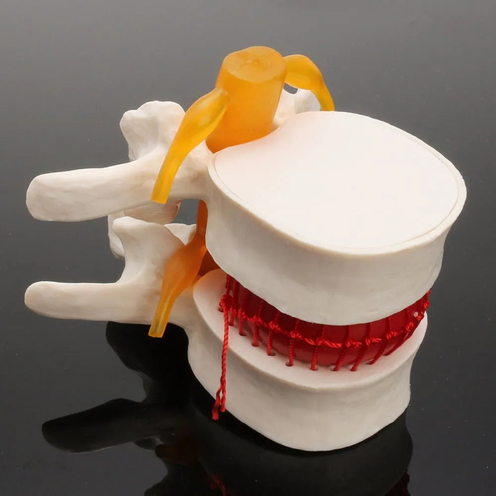 White PVC medical demonstration model showing lumbar intervertebral disc herniation anatomy