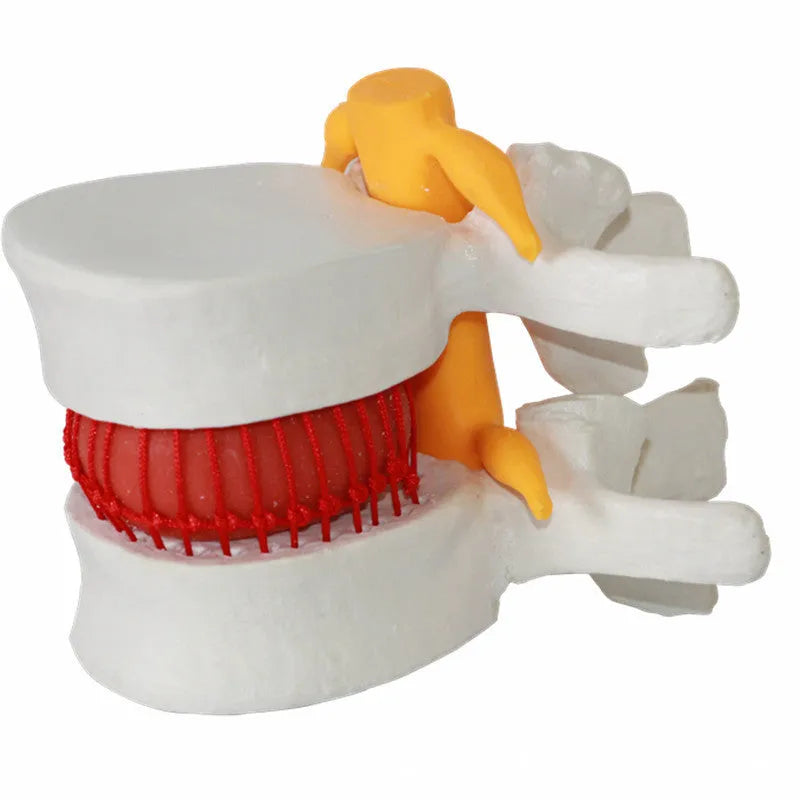 White PVC medical demonstration model showing lumbar intervertebral disc herniation anatomy