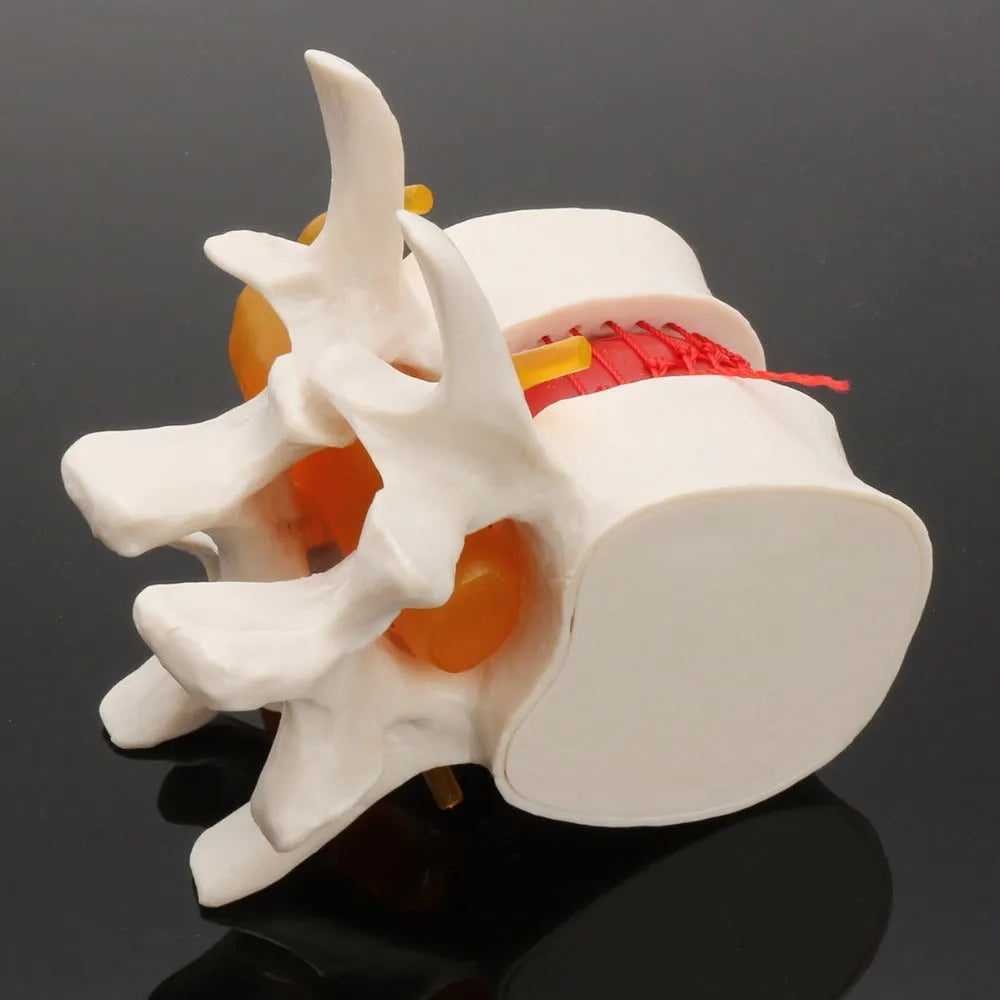 White PVC medical demonstration model showing lumbar intervertebral disc herniation anatomy