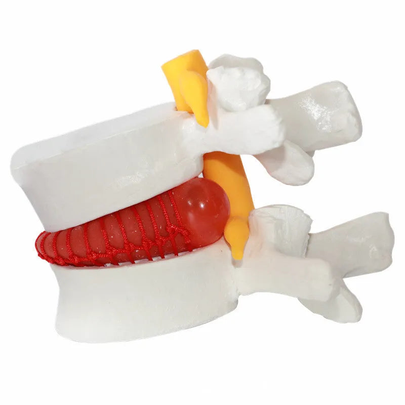White PVC medical demonstration model showing lumbar intervertebral disc herniation anatomy