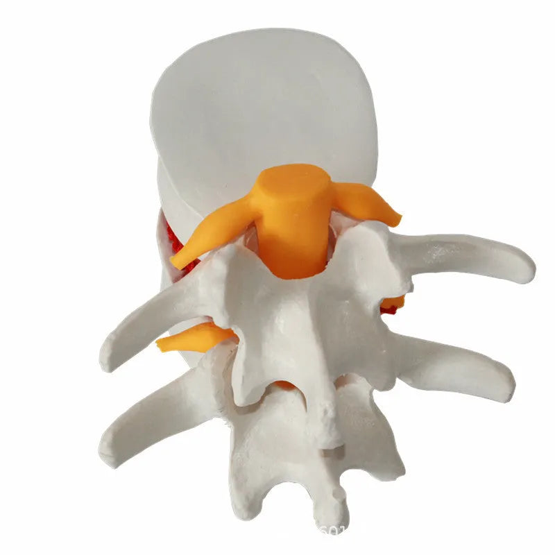 White PVC medical demonstration model showing lumbar intervertebral disc herniation anatomy
