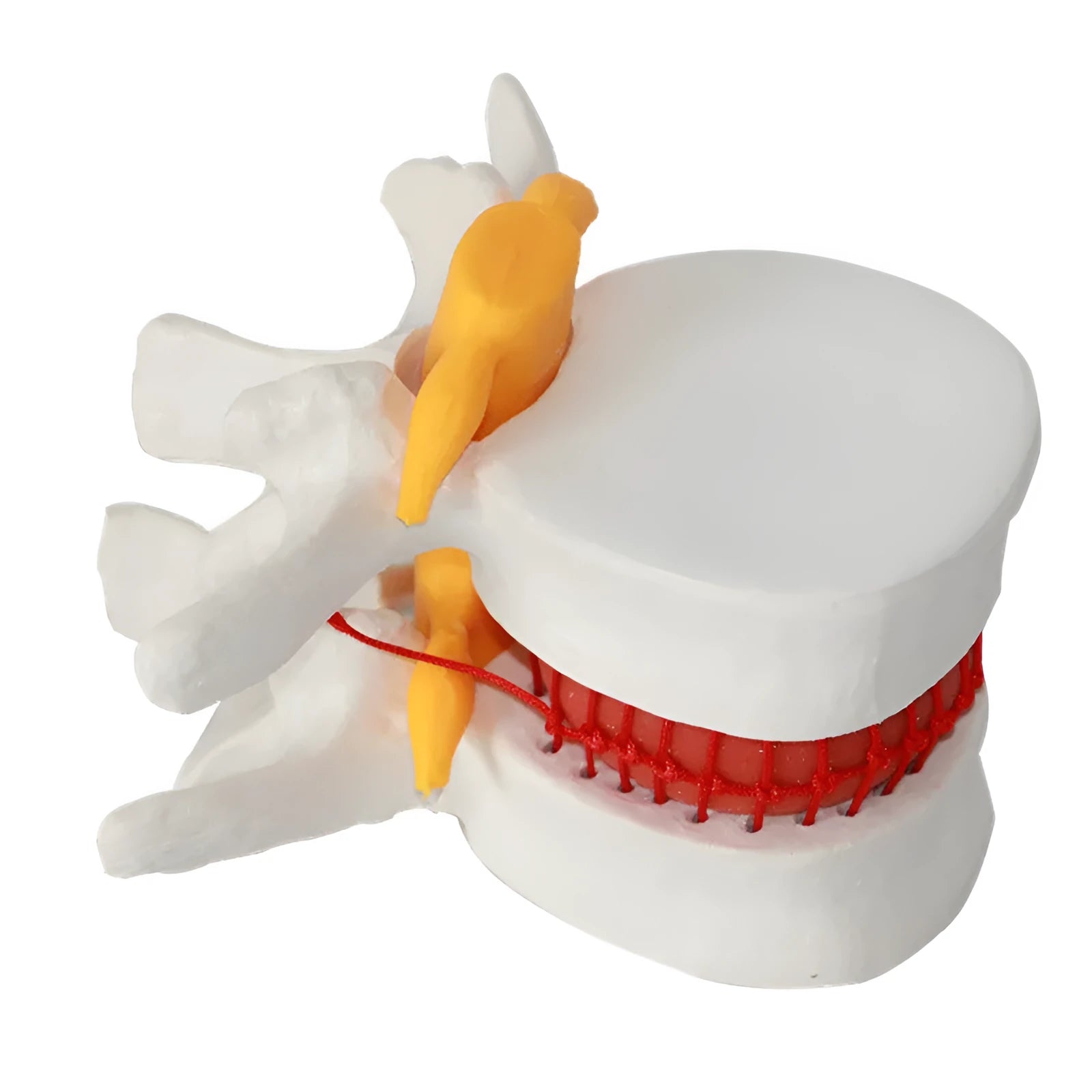 White PVC medical demonstration model showing lumbar intervertebral disc herniation anatomy