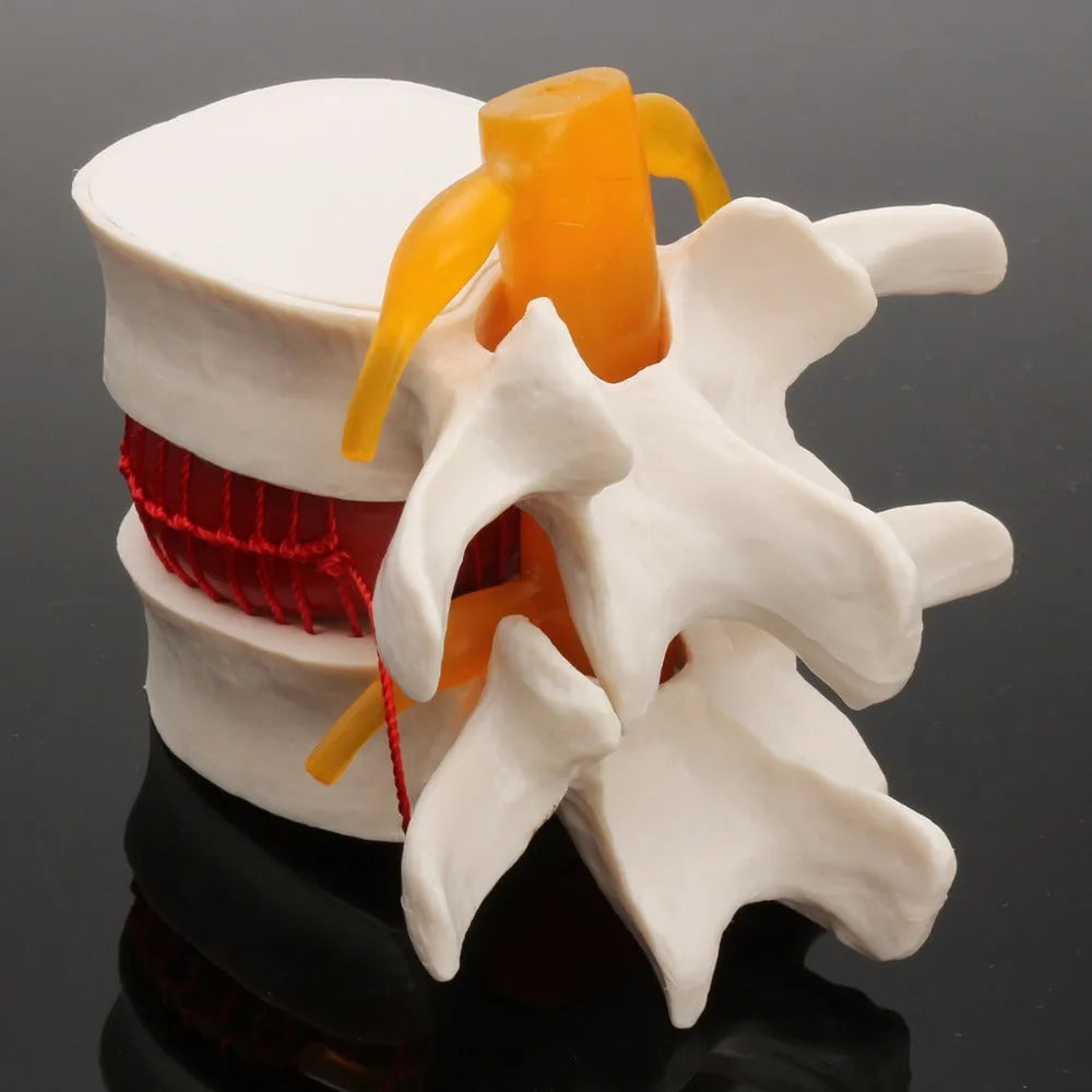 White PVC medical demonstration model showing lumbar intervertebral disc herniation anatomy