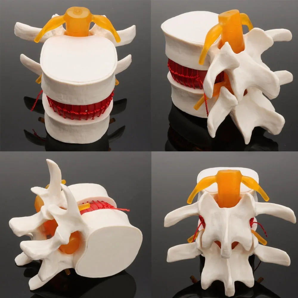 White PVC medical demonstration model showing lumbar intervertebral disc herniation anatomy